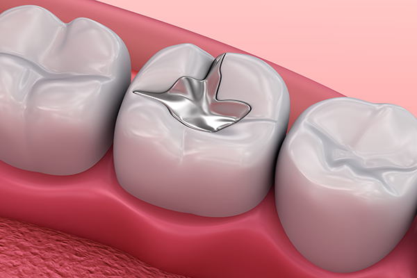 What To Know About Dental Filling Material Options